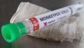 الأردن يعلن تسجيل أول إصابة بمرض جدري القرود