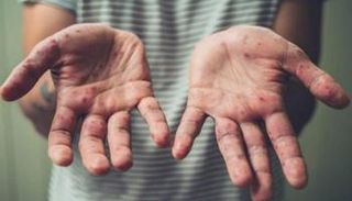 شخص مصاب بجدري القرود