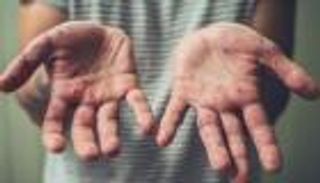 الصين تسجل أول إصابة بجدري القرود