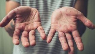 شخص مصاب بجدري القرود