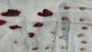 استخراج 49 حصوة من مرارة سيدة مصرية