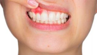 أمراض اللثة - تعبيرية