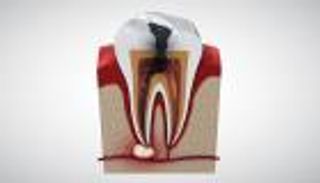 أسباب وعلاج التهاب جذور الأسنان (إنفوجراف)