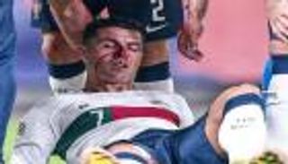 بعين سوداء.. كيف ظهر كريستيانو رونالدو بعد إصابته الدموية؟ (صورة)