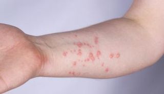 شخص مصاب بأعراض جدري القرود