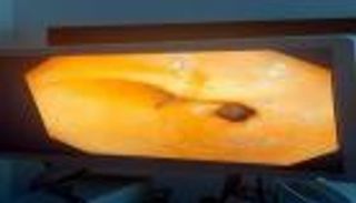 ابتلعتها بالخطأ.. تدخل منظاري ينقذ مريضة من إبرة خياطة في السعودية