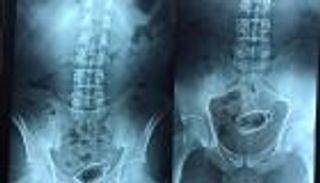 دخلت بـ"سيناريو خيالي".. استخراج زجاجة دواء من قولون مصري (صور)