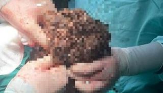 كتلة الشعر المستخرجة من معدة الفتاة