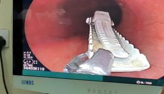 قراصة الشعر خلال استخراجها من معدة الصبي