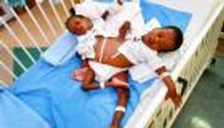 الحالة 59.. إجراء عملية فصل التوأم السيامي التنزاني “حسن وحسين" بالسعودية اليوم