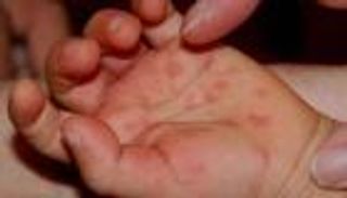 عدوى فيروسية بمدارس مكة.. و"الصحة" تُطمئن