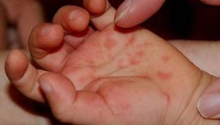 عدوى فيروسية