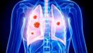 شهر التوعية بسرطان الرئة.. طبيب يوضح أبرز الأسباب وطرق الوقاية (خاص)