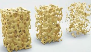 هشاشة العظام