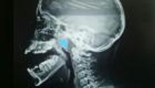 الذكاء الاصطناعي يكتشف أمراض الأنف والأذن والحنجرة