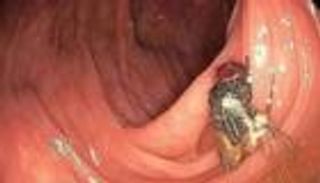 «ذبابة حية» في أمعاء رجل تحيّر الأطباء