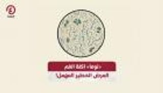 «نوما» آكلة الفم.. المرض الخطير المهمل!