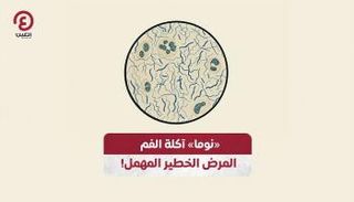 «نوما» آكلة الفم.. المرض الخطير المهمل!