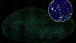 باحثة أمريكية تكشف لـ"العين الإخبارية" سر  فشل العلاج المناعي مع سرطان الرئة (حوار)