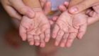 الحمى القلاعية هل تصيب الإنسان أم الحيوان؟ إليك طرق الوقاية من الفيروس