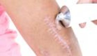 الطريقة الصحيحة لعلاج الندوب.. احذر من الشمس