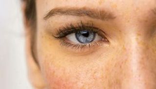 البقع البنية قد تكون مرحلة أولية للإصابة بسرطان الجلد