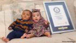 أبكر ولادة في العالم.. عام على ميلاد التوأم "أديا" و"أدريال" (صور)