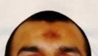 "زبيبة الصلاة" تثير الجدل في مصر.. تدين أم مرض جلدي؟ (خاص)