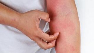يجب استشارة الطبيب مع بدء ظهور الطفح الجلدي