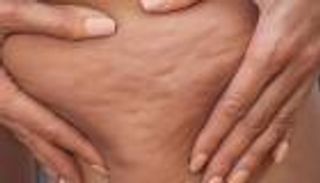 "السيلوليت" مشكلة جلدية مزعجة.. هل الكريمات المعالجة فعالة؟