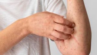 تظهر أعراض التهاب الجلد التأتبي في احمرار الجلد والحكة