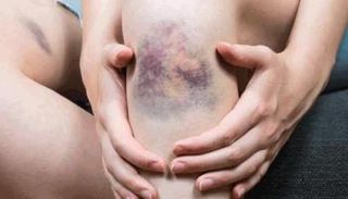 أسباب ظهور كدمات في الجسم وعلاجها