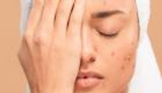 أسباب حب الشباب الهرموني وأنواعه وعلاجه بالمنتجات الطبيعية