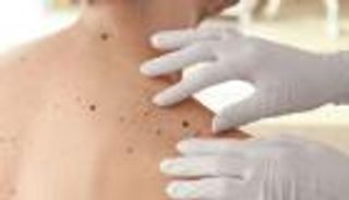 اختراق ثوري.. لقاح يمنع عودة سرطان الجلد