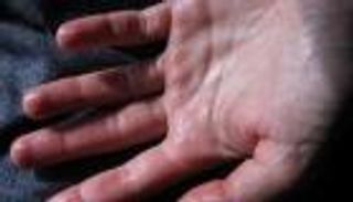 فرط تعرق اليدين.. الأسباب والحلول