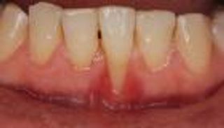 ما أسباب انحسار اللثة؟.. استشر الطبيب في هذه الحالة