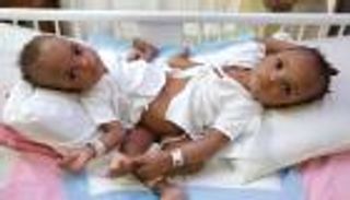 عملية فصل التوأم النيجيري "حسانة وحسينة" بالسعودية.. 14 ساعة لتحقيق المعجزة