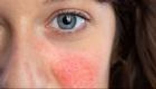 الذئبة الحمراء.. مرض مناعي يهدد النساء