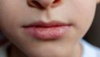 أسباب جفاف الشفاه.. ما علاقة التوتر النفسي؟