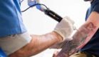 إزالة التاتو والوشم من الجلد.. 3 أضرار لليزر