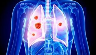 التوصل لعلاج جديد لسرطان الرئة- أرشيفية