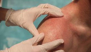 حروق الشمس الشديدة فتستلزم استشارة الطبيب فورا