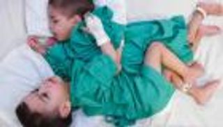 بسام وإحسان.. غدا فصل توأم سيامي سوري بالسعودية في عملية تستغرق 9 ساعات ونصفاً (صور)