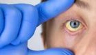 الخطر يقترب.. ارتفاع حالات الإصابة بالتهاب الكبد الفيروسي في لبنان