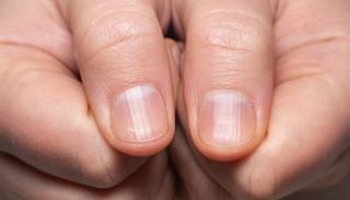 عدم نمو الأظافر يشير إلى نقص فيتامين ب12