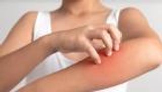 حساسية العرق المزعجة.. كيف تفلت منها؟