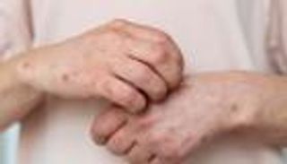 منشور خطير عن سرطان الجلد يجتاح "السوشيال ميديا".. ما علاقة واقي الشمس؟