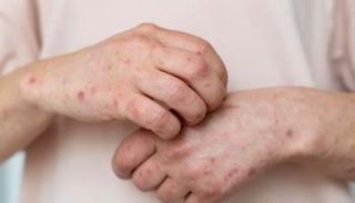 سرطان الجلد مرض معروف منذ آلاف السنين