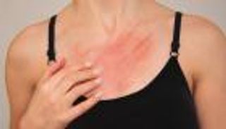 انتشار الجرب يثير القلق في بريطانيا