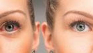 شهر التوعية بمرض الجلوكوما.. «سارق البصر» يهدد 80 مليون شخص